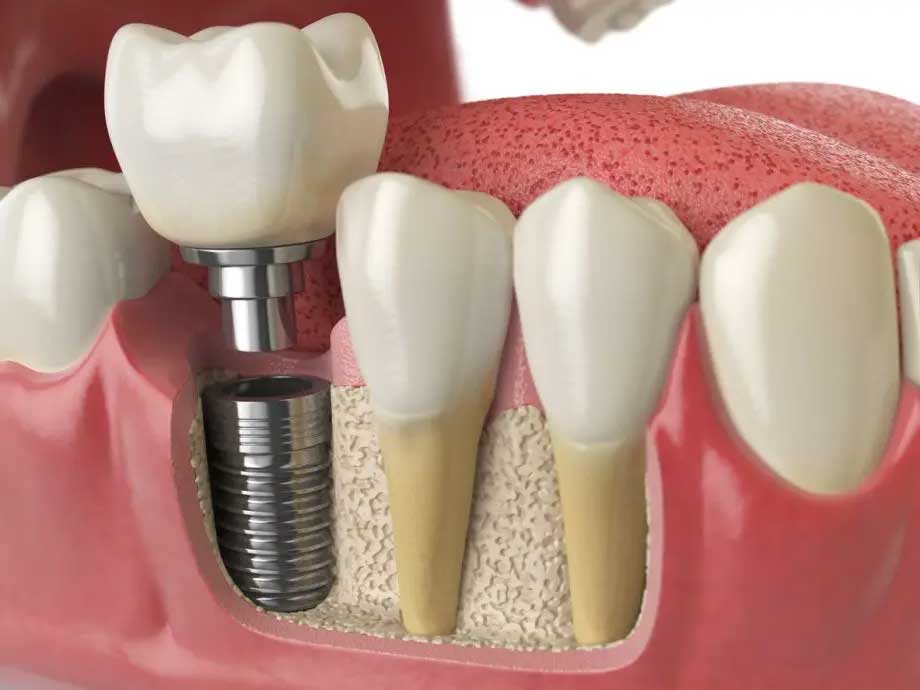 dental-implants